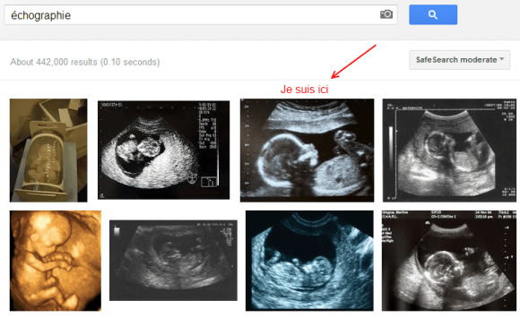 Résultat échographie